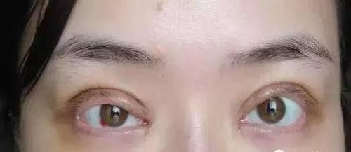 郑州双眼皮爆料案件最新,揭开整形行业潜规则真相